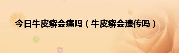 今日牛皮癣会痛吗（牛皮癣会遗传吗）